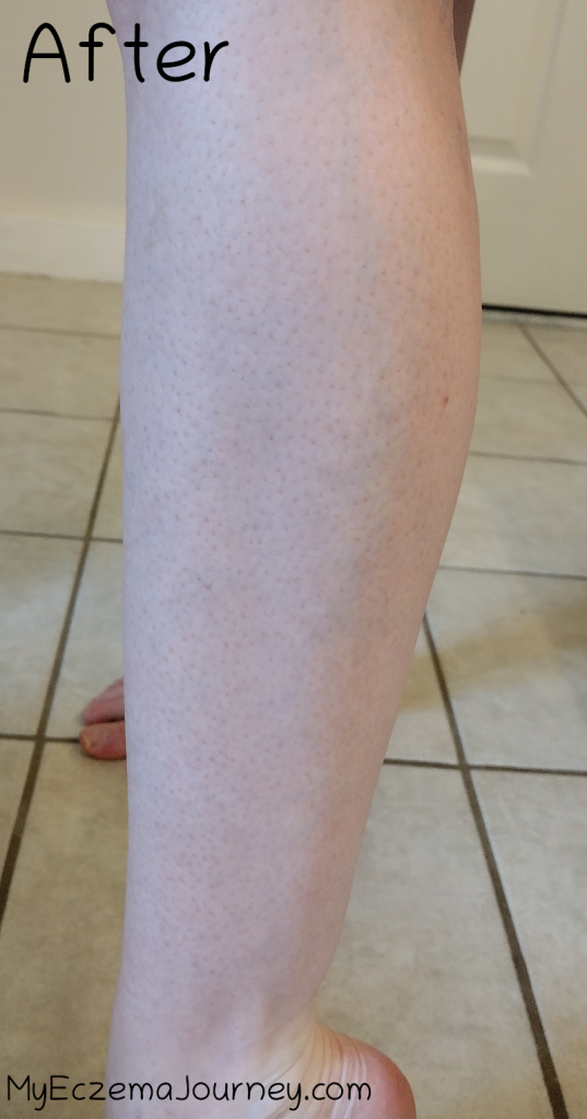 leg without rashes after eczema treatment