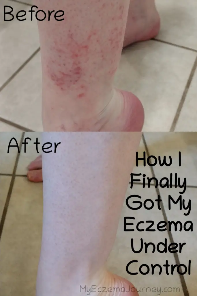 before and after eczema on leg with text overlay: how I finally got my eczema under control