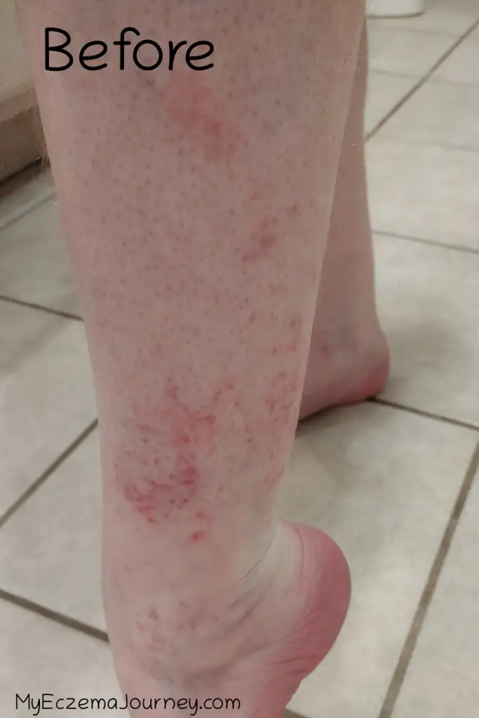 eczema rashes on leg with text overlay: before